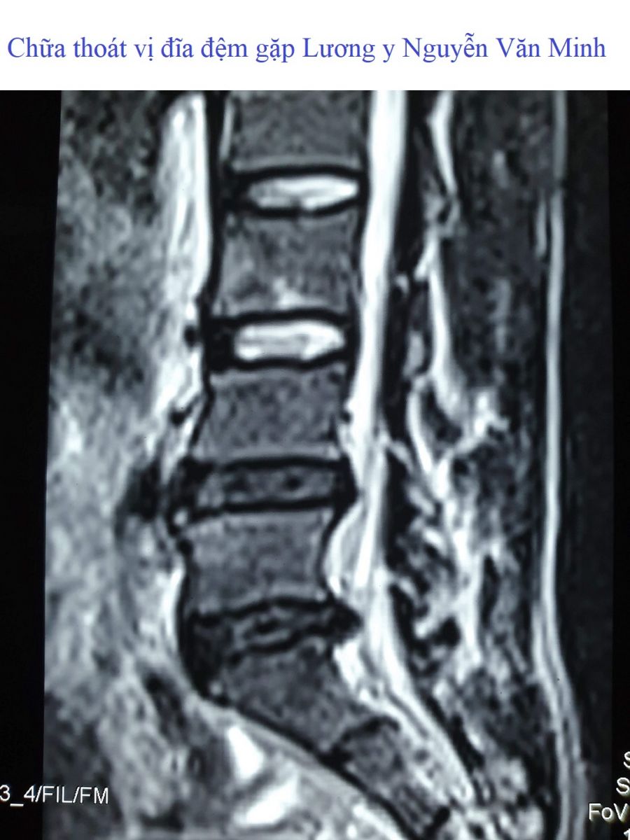 Chữa thoát vị đĩa đệm gặp Lương y Nguyễn Văn Minh